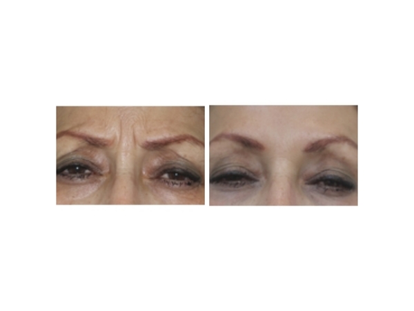 BOTOX - GLABELLAR - FORHEAD - BEFORE AND AFTER