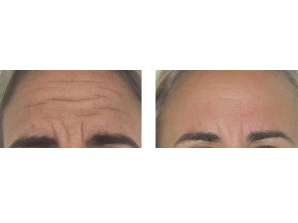 BOTOX - GLABELLAR- FOREHEAD - BEFORE AND AFTER