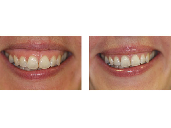 BOTOX - GUMMY SMILE - BEFORE AND AFTER