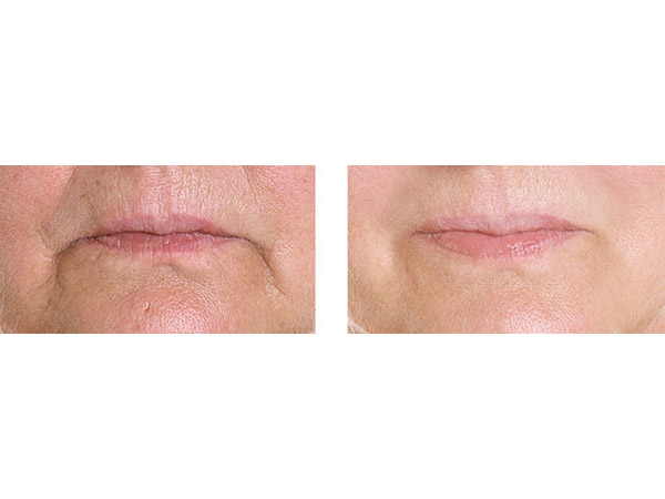BOTOX - MARIONETTE LINES - BEFORE AND AFTER