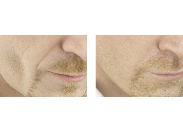 DERMAL FILLERS - CHEEKS - BEFORE AND AFTER