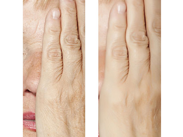 DERMAL FILLERS - HANDS - BEFORE AND AFTER