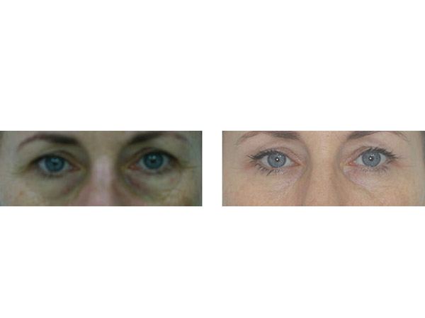 DERMAL FILLERS - HOLLOW UNDER EYES - BEFORE AND AFTER