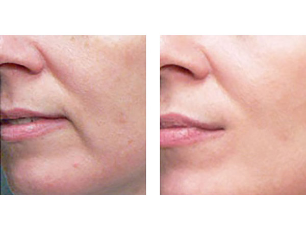 DERMAL FILLERS - MARIONETTE LINES - BEFORE AND AFTER