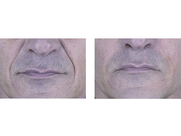 DERMAL FILLERS - NASIO LABIAL FOLDS - BEFORE AND AFTER