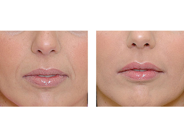 DERMAL FILLERS - NASIO LABIAL FOLDS - BEFORE AND AFTER