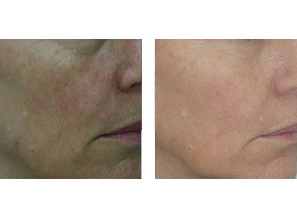 THREADS - SKIN TIGHTENING - BEFORE AND AFTER