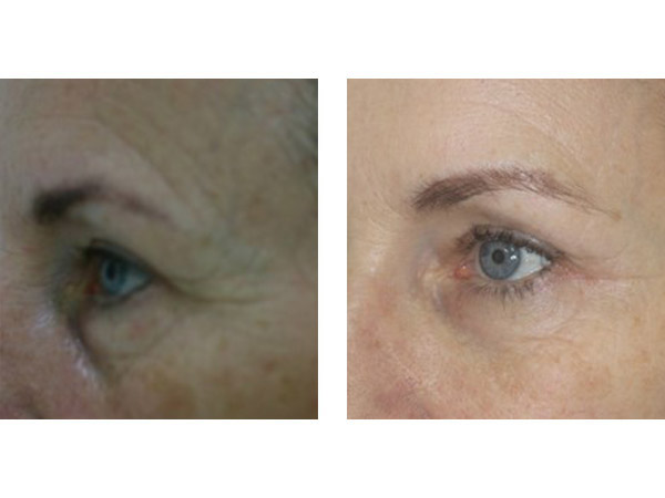 DERMAL FILLERS - EYE BROW LIFT - BEFORE AND AFTER