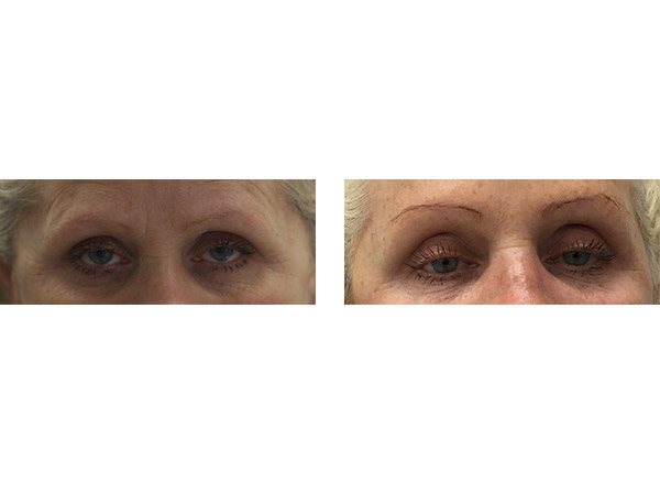 DERMAL FILLERS - HOLLOW TEMPLE - BEFORE AND AFTER