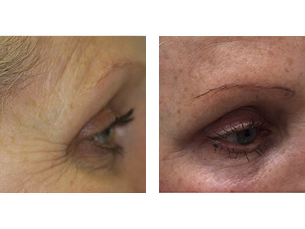 DERMAL FILLERS - HOLLOW TEMPLE - BEFORE AND AFTER