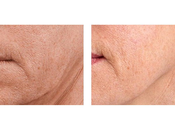 BOTOX - JAW LINE DEFINITION -DECOLLETE - BEFORE AND AFTER