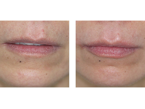 DERMAL FILLERS - LIPS AUGMENTATION - BEFORE AND AFTER