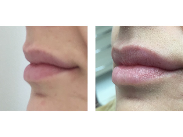 DERMAL FILLERS - LIPS AUGMENTATION - BEFORE AND AFTER
