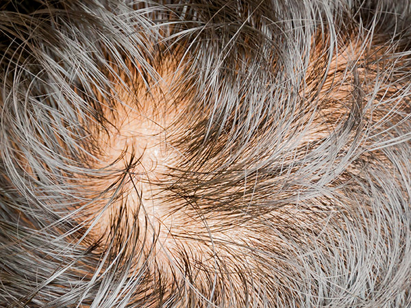 Hair loss - Platelet Rich Plasma (PRP)