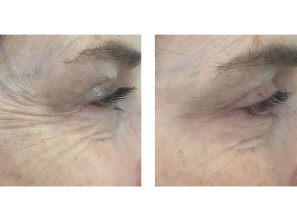 BOTOX - CROW'S FEET - BEFORE AND AFTER