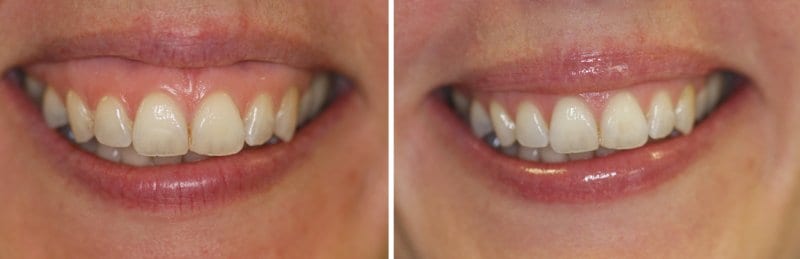 GET RID OF A GUMMY SMILE WITHOUT SURGERY