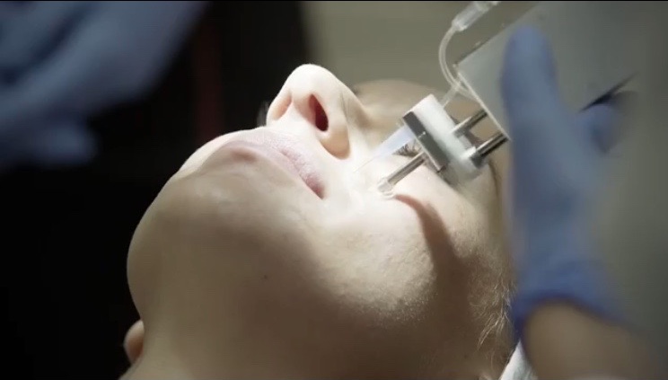 MESOTHERAPY FOR PLUMP CHEEKS