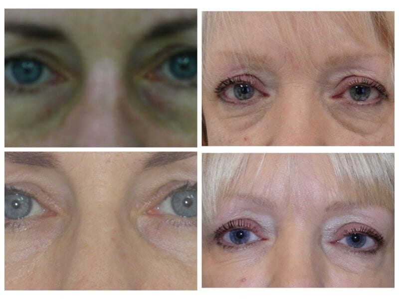 EYE REJUVENATION