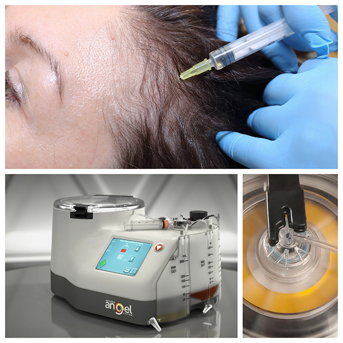 Consider Mesotherapy or PRP to revive and restore healthy, thick and shiny hair