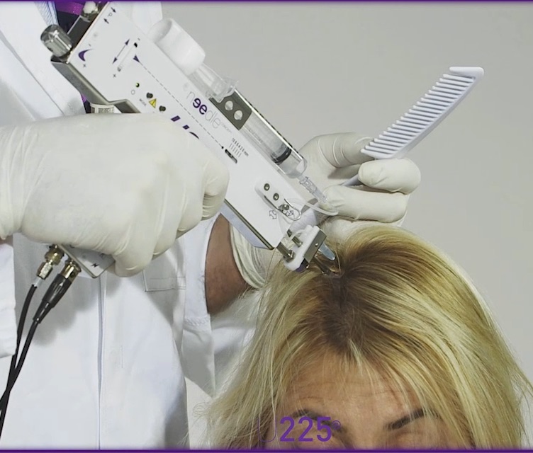 Mesotherapy or PRP for healthy and shiny hair