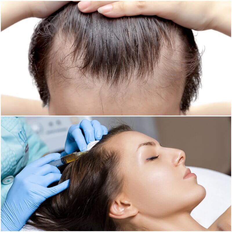 What is Alopecia and what can be done ?