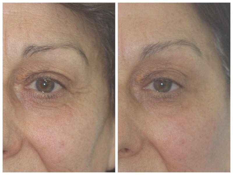 Non-surgical brow lift  with Botox