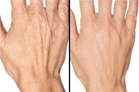 WHICH FILLER TO GET RID OF THE WRINKLES ON YOUR HANDS ?