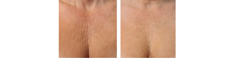 PREVENT WRINKLES ON YOUR NECK AND DECOLLETAGE WITH NU-DERM FROM OBAGI