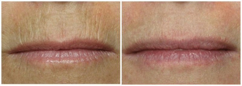 HOW TO GET RID OF WRINKLES ABOVE YOUR LIPS ?