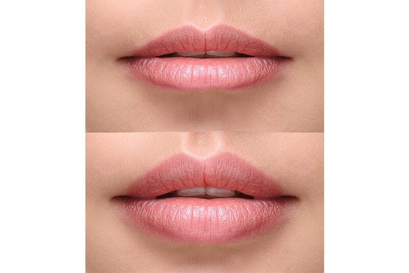THE BEST LIP FILLER TREATMENT IN LONDON TO ACHIEVE VOLUPTUOUS AND NATURAL LIPS!