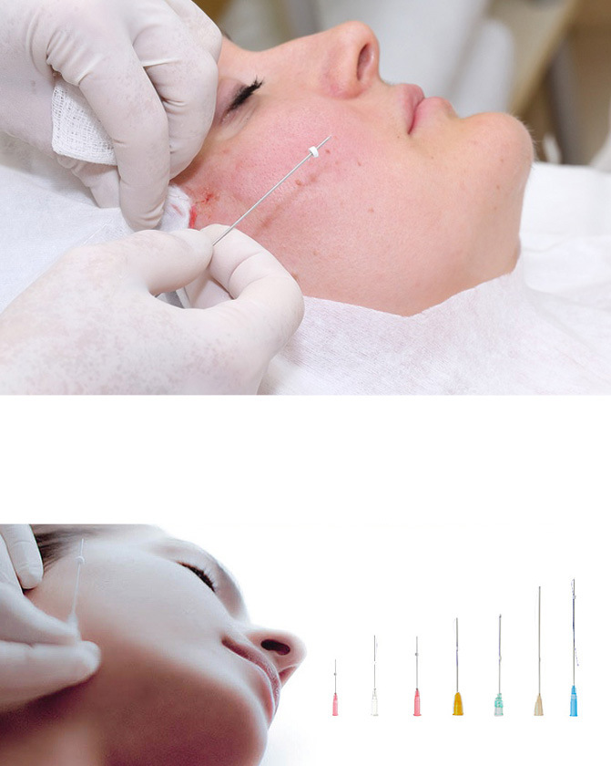 SKIN REJUVENATION WITH POLYDIOXANONE THREADS (PDO)