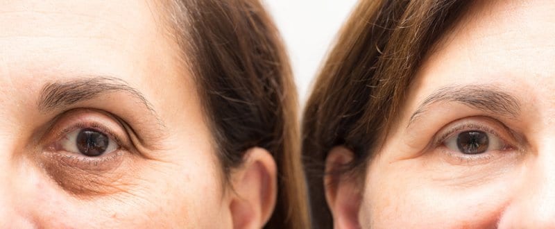 OBAGI TO GET RID OF TIRED LOOKING EYES AND DARK CIRCLES