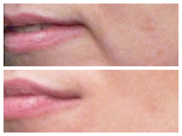 DERMAL FILLERS TO SOLVE MARIONETTE LINES