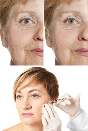 PROFHILO OR DERMAL FILLERS?