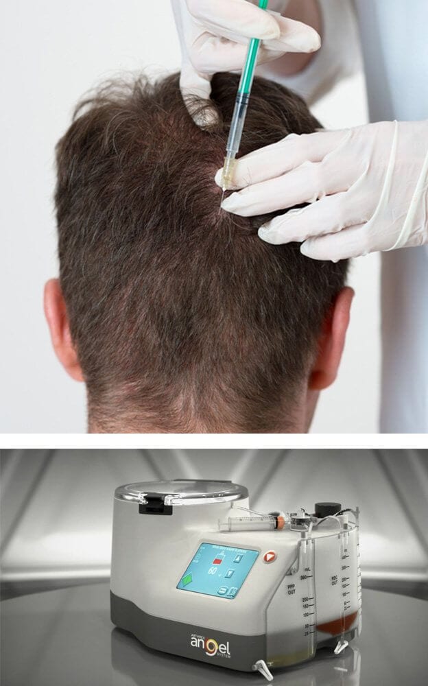 DOES PRP WORKS FOR HAIR LOSS ?