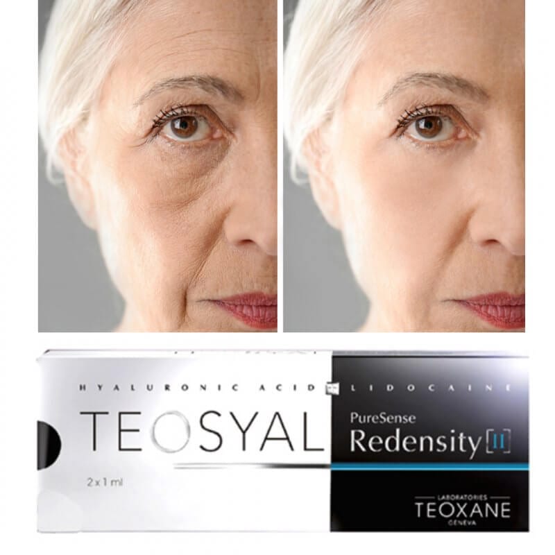 TEOSYAL REDENSITY II FOR A REFRESHED LOOK!