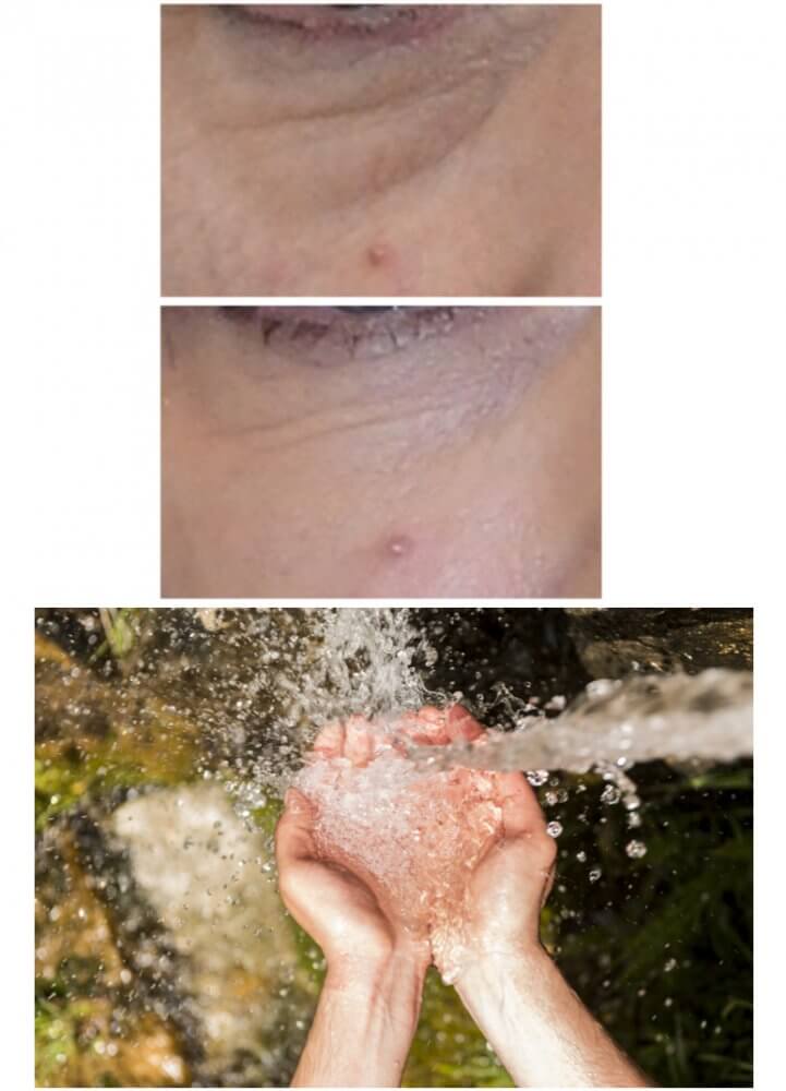 Understanding Eye Bags and Dark Circles