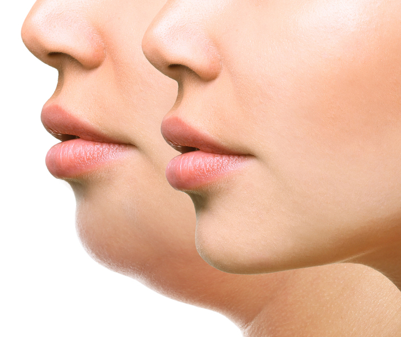 GET RID OF YOUR DOUBLE CHIN WITH KYBELLA!