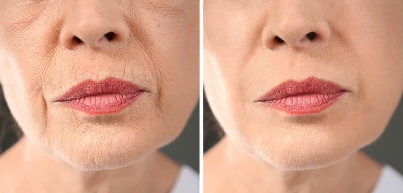 HOW TO GET RID OF SMOKERS LINES