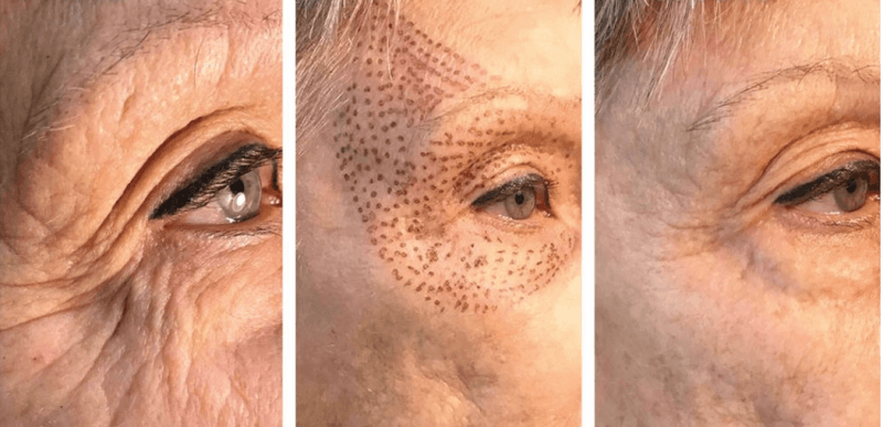 WHAT IS PLASMAGE AND WHAT IS IT USED FOR?