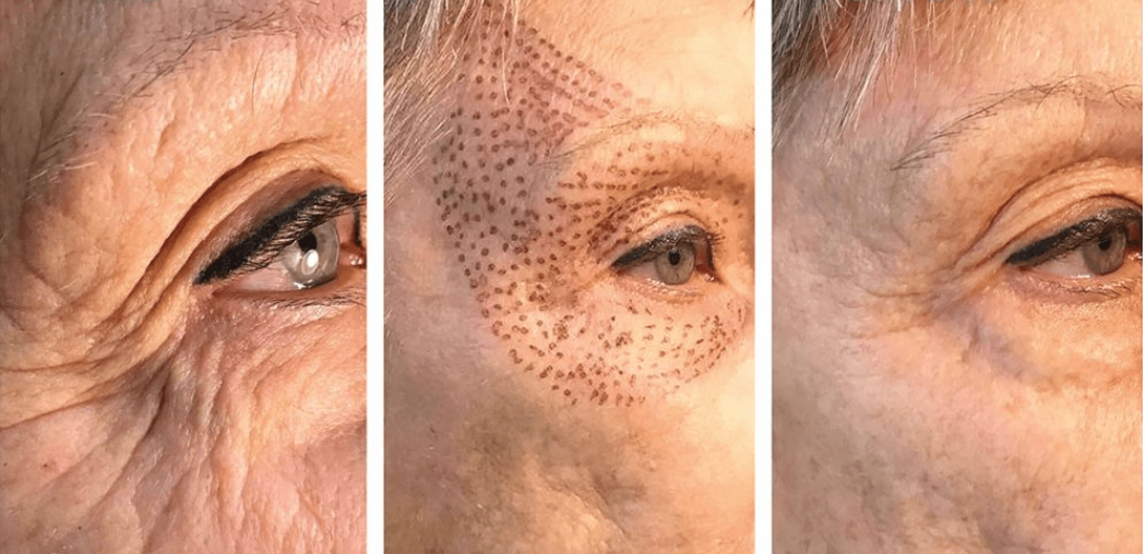 before and after blepharoplasty plasmage The London Facial Care