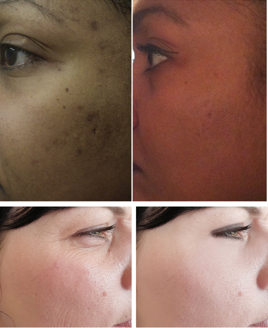 OBAGI BLUE PEEL AND CHEMICAL PEELS
