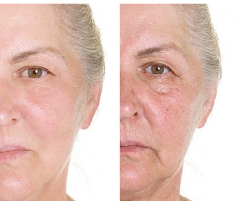 MD Codes | Fillers | Juvederm: Book Now!