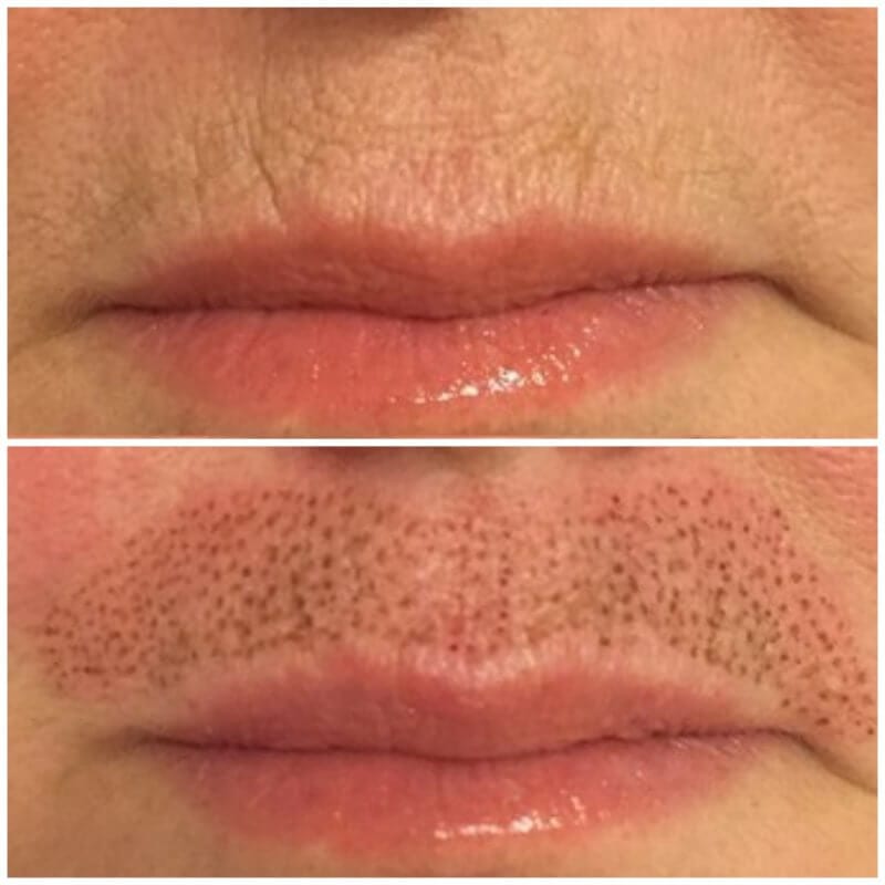 PLASMAGE FOR SMOKER LINES | At theLondonFacialCare | Dr Fern