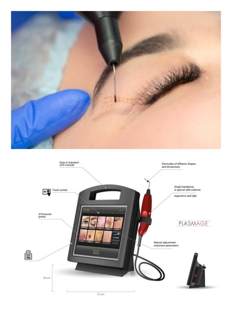 BLEPHAROPLASMAGE FOR EYE LIFT