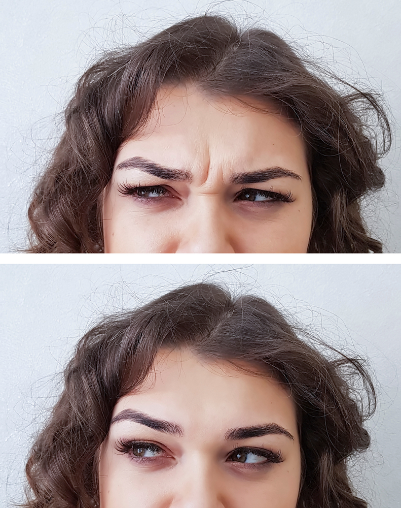HOW BOTOX PREVENT AND SMOOTH EXISTING WRINKLES The London Facial Care