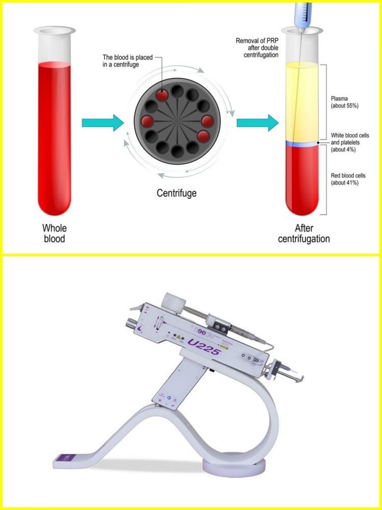 PLATELET RICH PLASMA IN LONDON - THE BEST AUTOLOGOUS TREATMENT