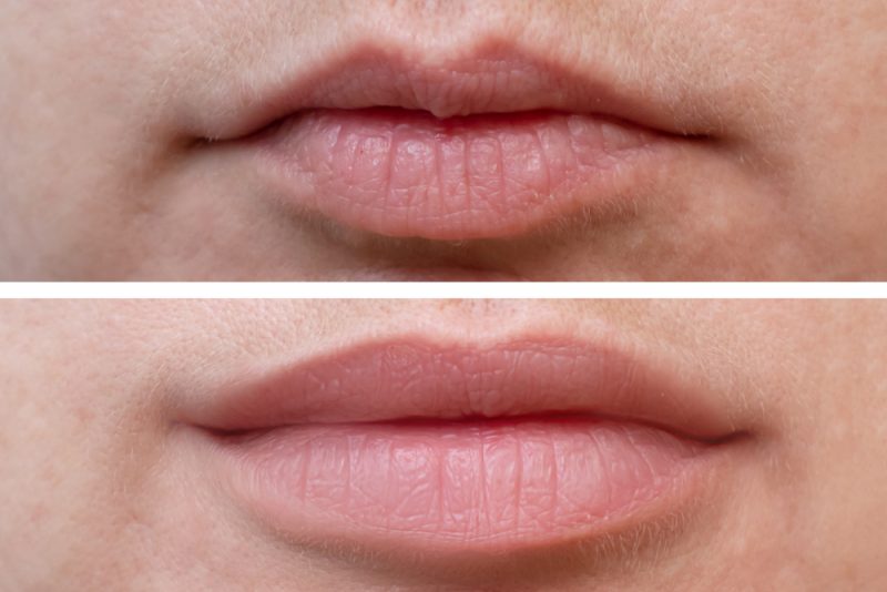 LIP FILLERS LONDON