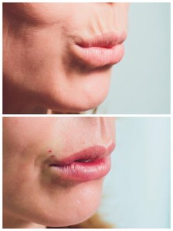 HOW DO I GET RID OF SMOKERS LINES ?