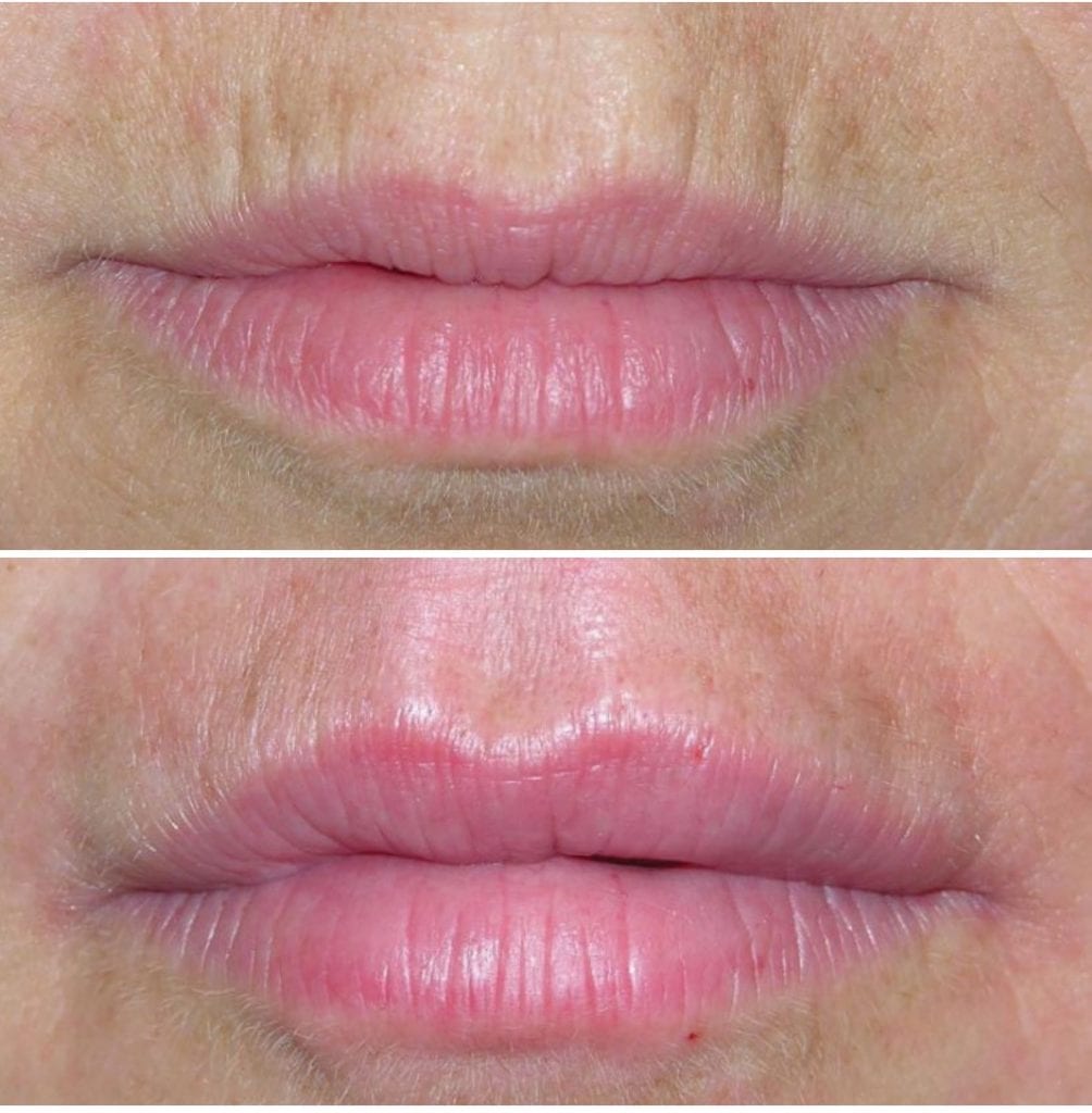 Before and after of lip filler injection